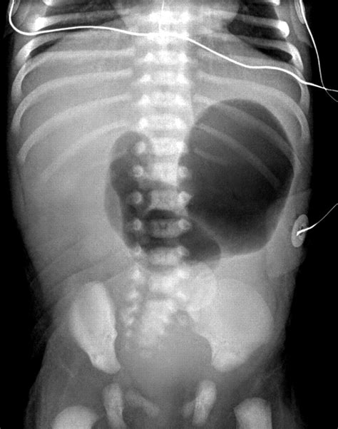 Double Bubble Duodenal Atresia