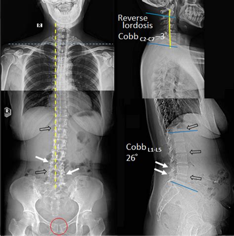 Standing Plain Radiographs At Initial Presentation Antero Posterior