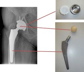 Zementierte Teilzementiert Zementfreie Prothesen Arthrowl B Nde