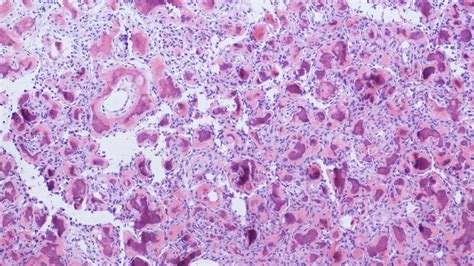 Juvenile Psammomatoid Ossifying Fibroma Atlas Of Pathology