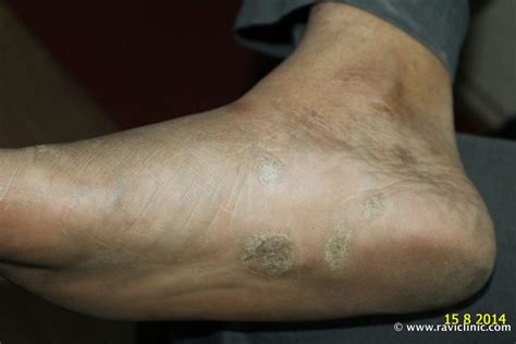 A case of Psoriasis at Feet – Homeo Energy