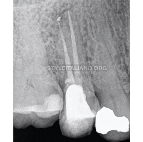 Alternative Method For Removing Fractured Instrument A Case Report Style Italiano Endodontics