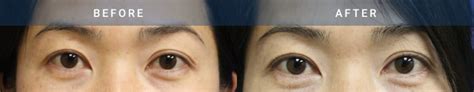 Asian Eyelid Surgery Case Radiance Surgery Aesthetic Medicine