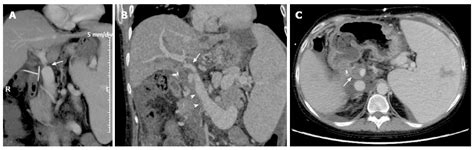 Post Operative Imaging In Liver Transplantation State Of The Art And