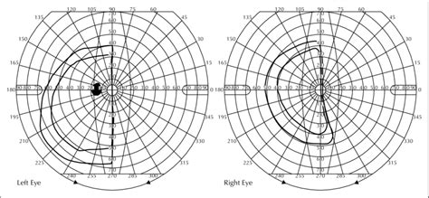 Post Operative Visual Field Showing A Right Homonymous Hemianopia Download Scientific Diagram