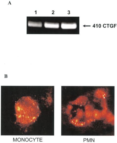 Presence Of Connective Tissue Growth Factor Ctgf Mrna And Protein In