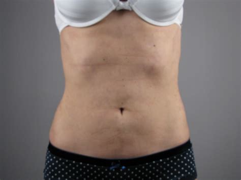 Selston Cosmetic Clinic Vaser Lipo Before And After Months Later