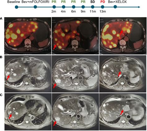 Frontiers Rnf Is Associated With Genomic Features And Clinical