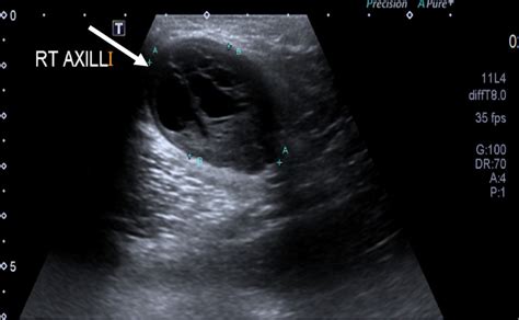 Axillary Artery Ultrasound