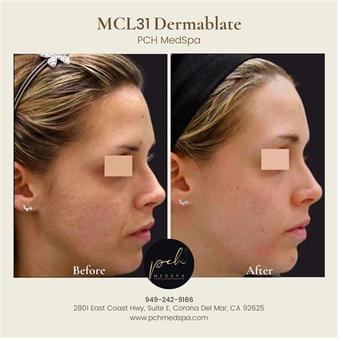 MCL31 Dermablate Laser Fractional Laser PCH MedSpa