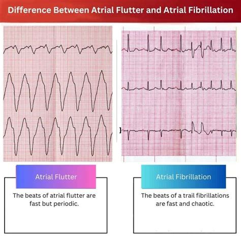 Atrial Flutter Vs Atrial Fibrillation Difference And Comparison