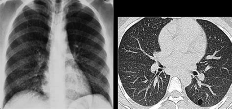 Pneumocystis Carinii Pneumonia Atypical Features Chest X Ray Shows Download Scientific Diagram