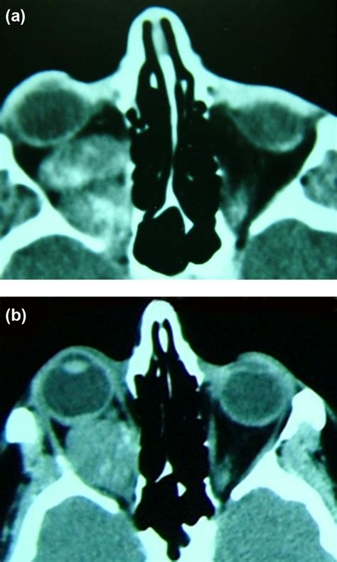 Contrast Enhanced Axial Computed Tomography Ct Scan Of The Orbit At