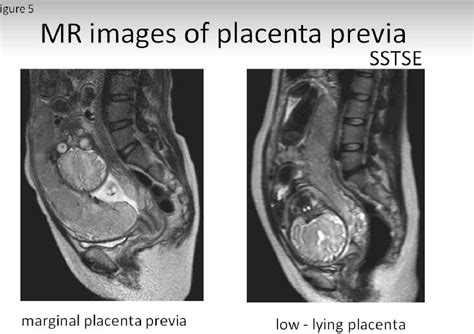 Figure From Detection Of Placenta Previa The Role Of Mri Semantic