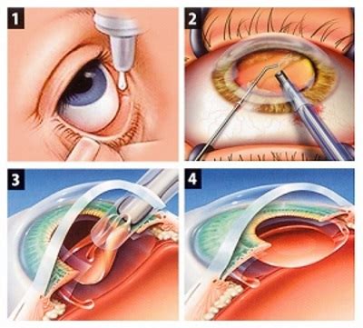 Chirurgie Cataracte Turquie Prix Chirurgie Des Yeux Correction Vision