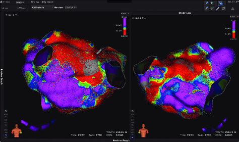 Left Atrial Voltage Map