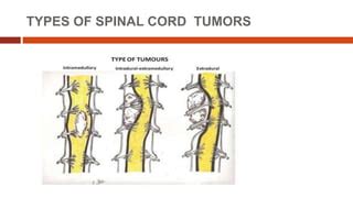 Spinal cord tumors | PPT