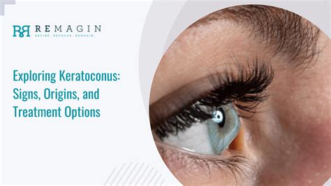 Understanding Keratoconus Symptoms Causes And Treatment Strategies