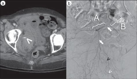 A Contrast Enhanced Axial Computed Tomography Image Demonstrates