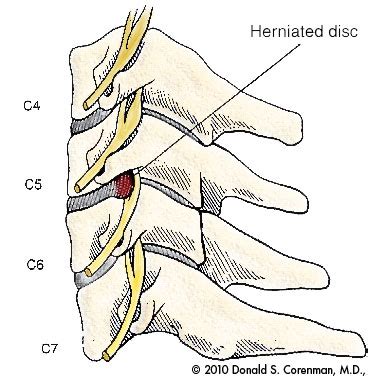 cervical radiculopathy spine specialist