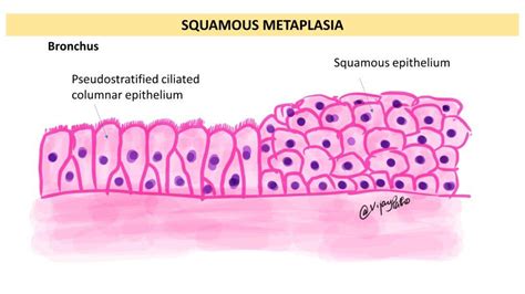 Metaplasia: Types and Causes - Pathology Made Simple