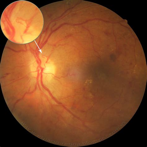 ESPACIO RETINA Retinopatía diabética proliferativa