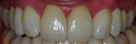 Different Types Of Dental Veneers Plaza Dental