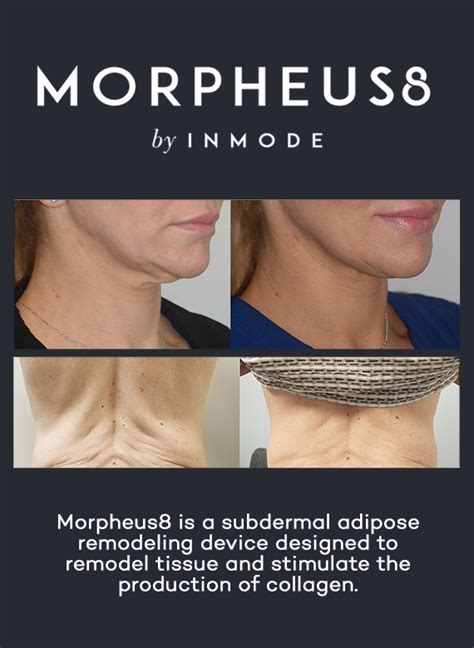 Morpheus8 Skin Tightening Near Me In Oconomowoc Wisconsin Tighten