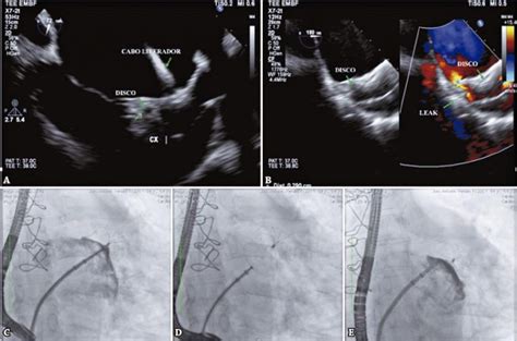 Complex Percutaneous Left Atrial Appendage Closure Using The Lambre