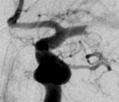 Carman Meniscus Sign