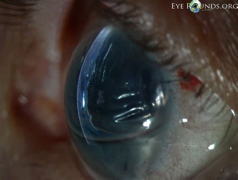 Corneal Edema Causes Symptoms And Treatment Options