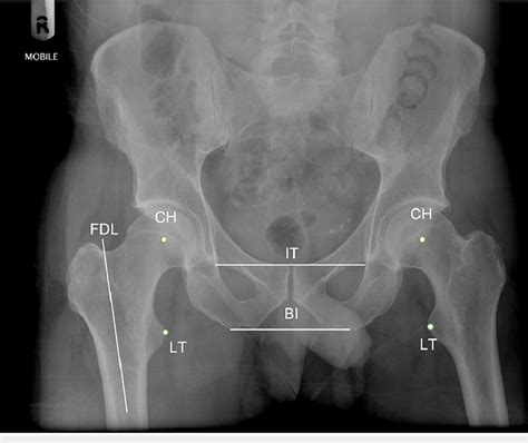 An Anteroposterior Ap Radiograph Of The Pelvis Shows The Different