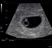 Yolk sac | Radiology Reference Article | Radiopaedia.org