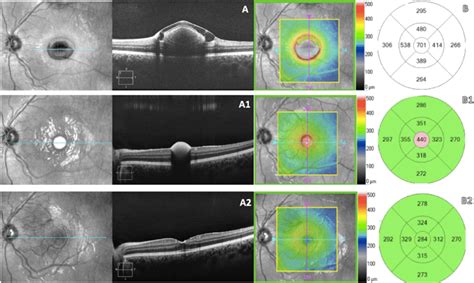 A Swept Source Optical Coherence Tomography Ss Oct On Presentation