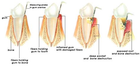 Root Planning Prestige Dental Care My