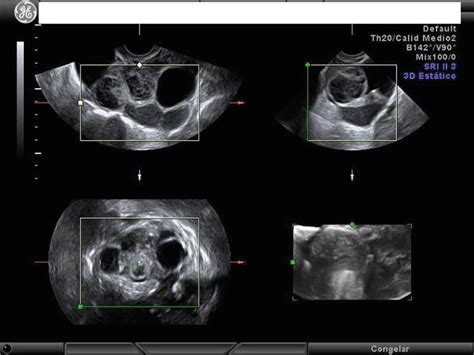 Malignant Ovarian Tumors Serousmucinousendometrioidclear Cell