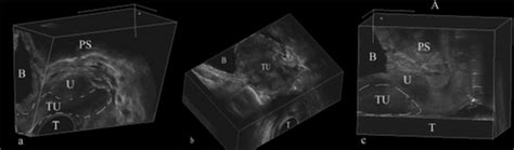 Evaluation Of Vaginal Cysts And Masses By 3‐dimensional Endovaginal And