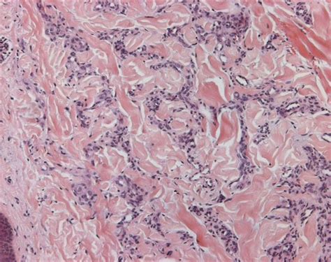 Pathology Outlines Microvenular Hemangioma