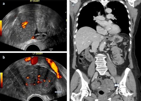 Bilateral Ovarian Masses Which Demonstrated Increased Vascularity Were