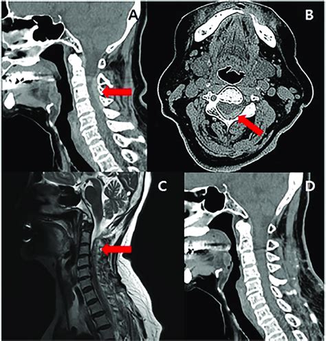 Epidural Hematoma Spine Ct