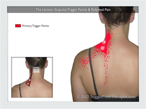 Levator Scapulae Trigger Points: Frankenstein Pain ...