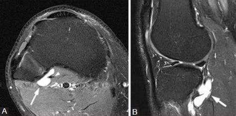 Popliteus Ganglion A 34 Year Old Woman With Knee Pain Open I