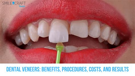 Teeth Veneers