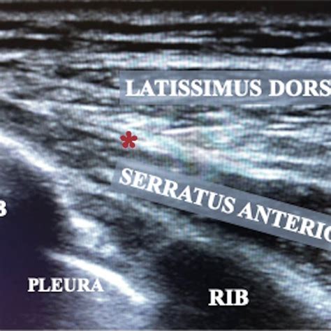 Ultrasound-guided serratus anterior plane block. Ultrasound transducer ...