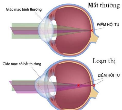 Chuyên Gia Giải Thích Về Hình ảnh Mắt Bị Cận Thị Và Cách Khắc Phục