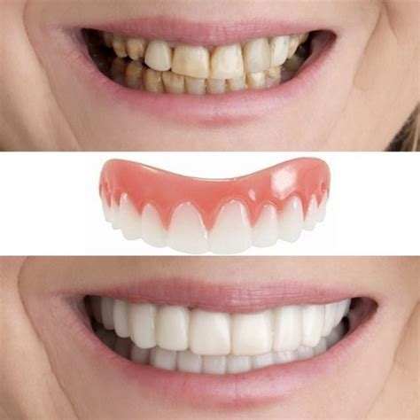 Что представляют собой Perfect Smile Veneers? - 500pokupok