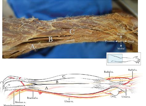 Figure From Supernumerary Head Of The Biceps Brachii Muscle An