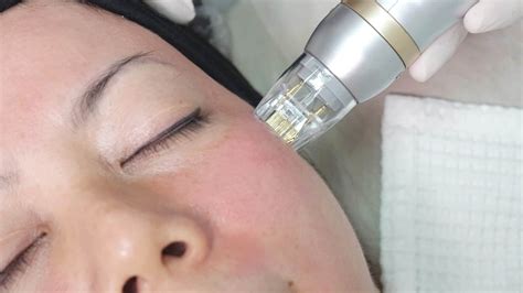 Is Sylfirm X Microneedling A Good Acne Scar Treatment