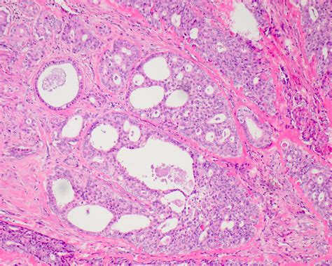 Pathology Outlines Sclerosing Polycystic Adenoma