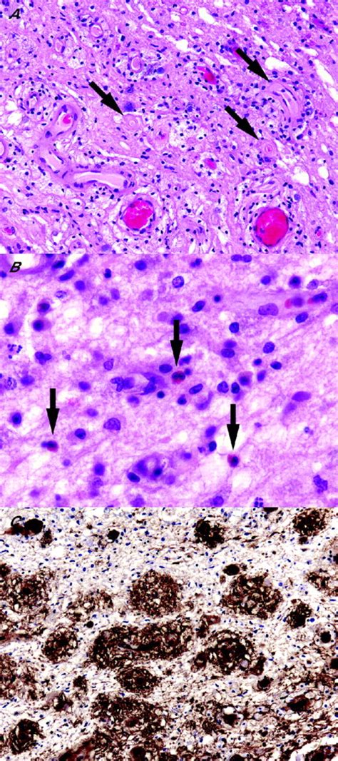 Demyelinating Diseases Journal Of Clinical Pathology